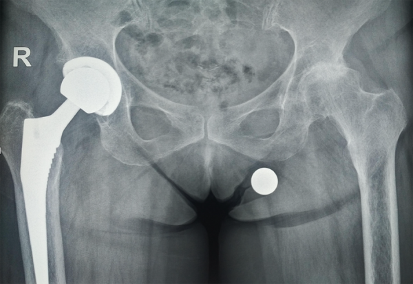 Ολικη αρθροπλαστικη ισχυου