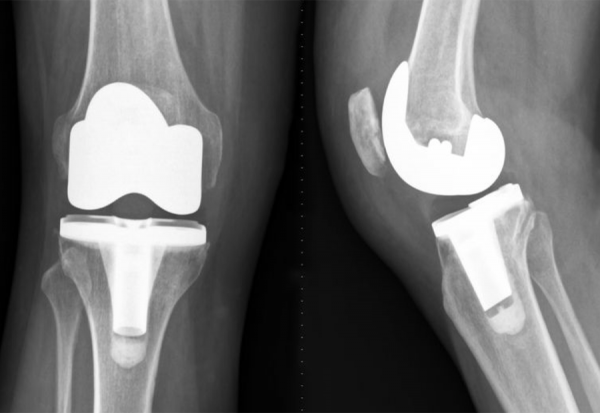 Ολικη Αρθροπλαστικη γονατος