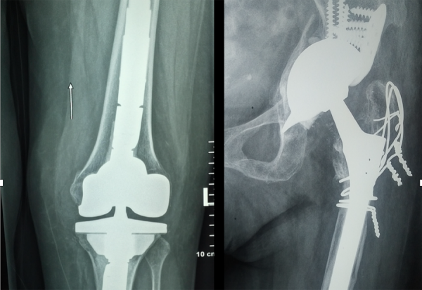 Αναθεωρησεις αρθροπλαστικων ισχιου και γονατος