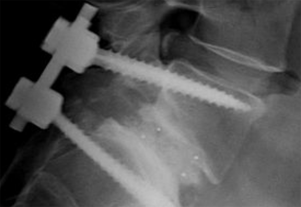 Χειρουργικη σπονδυλικης στηλης